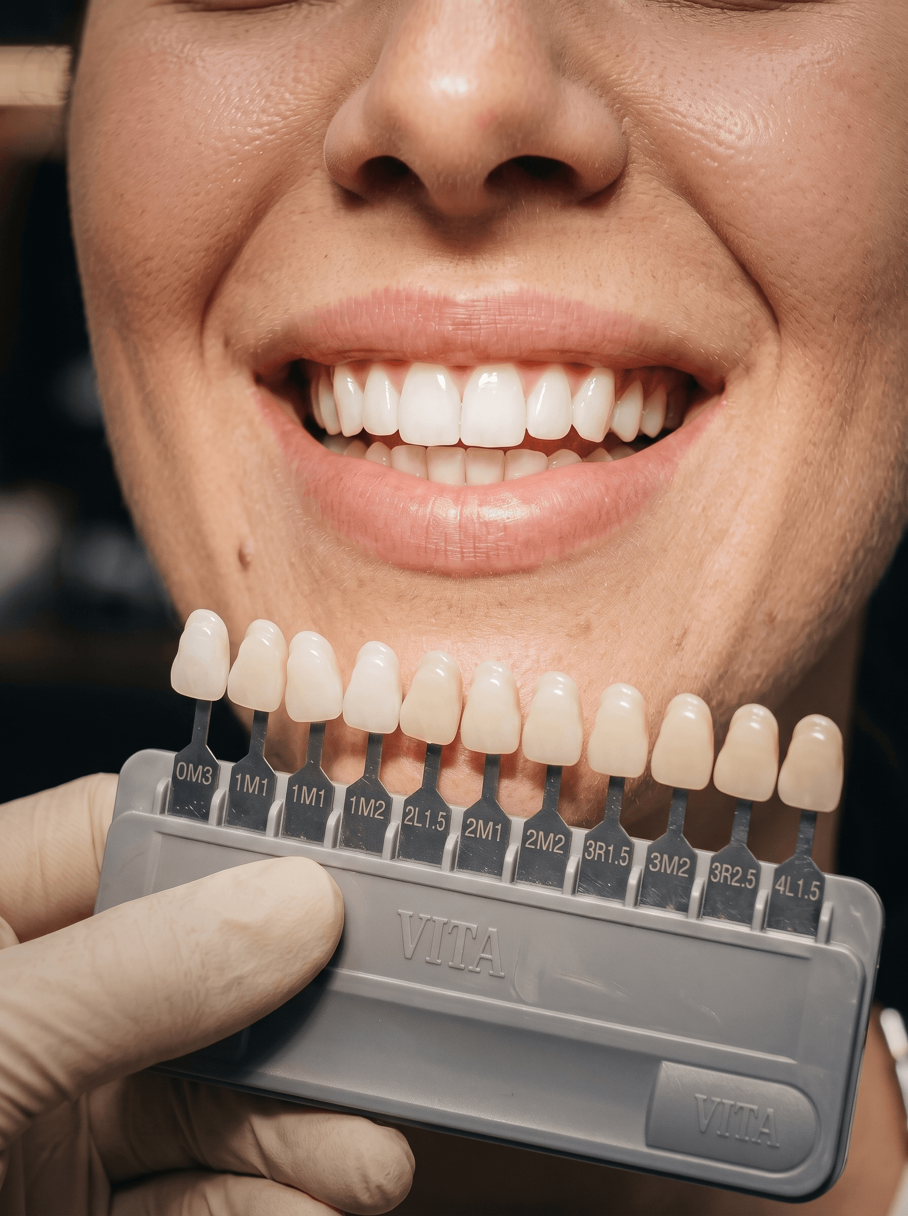 Teeth Whitening at Texas Implant & Dental Specialists
